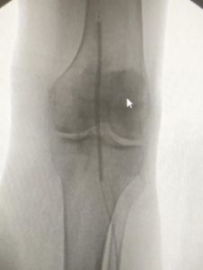 Critical Limb Ischemia
