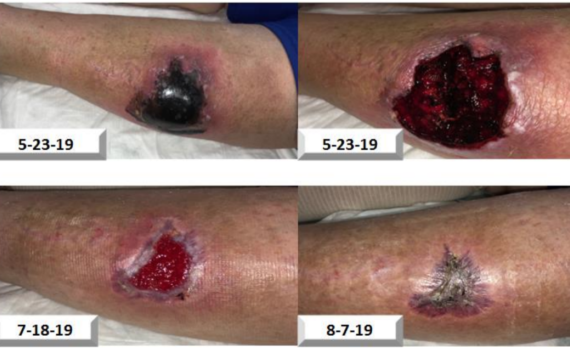 Traumatic Hematoma to Left Leg