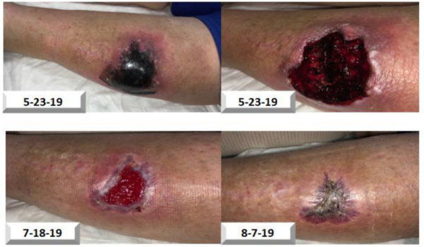 Traumatic Hematoma to Left Leg