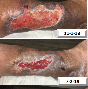 Healing Progress