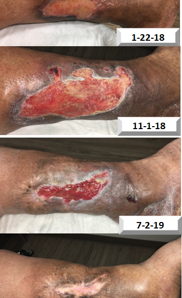 Healing Progress