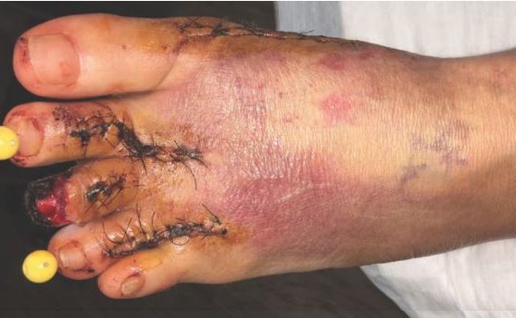 Using Near Infrared Spectroscopy Imaging to Manage Critical Limb Ischemia