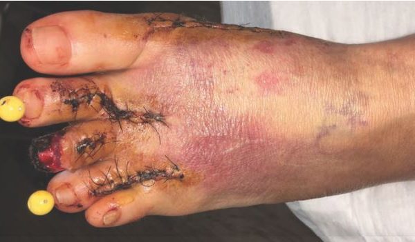 Using Near Infrared Spectroscopy Imaging to Manage Critical Limb Ischemia