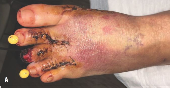 Using Near Infrared Spectroscopy Imaging to Manage Critical Limb Ischemia