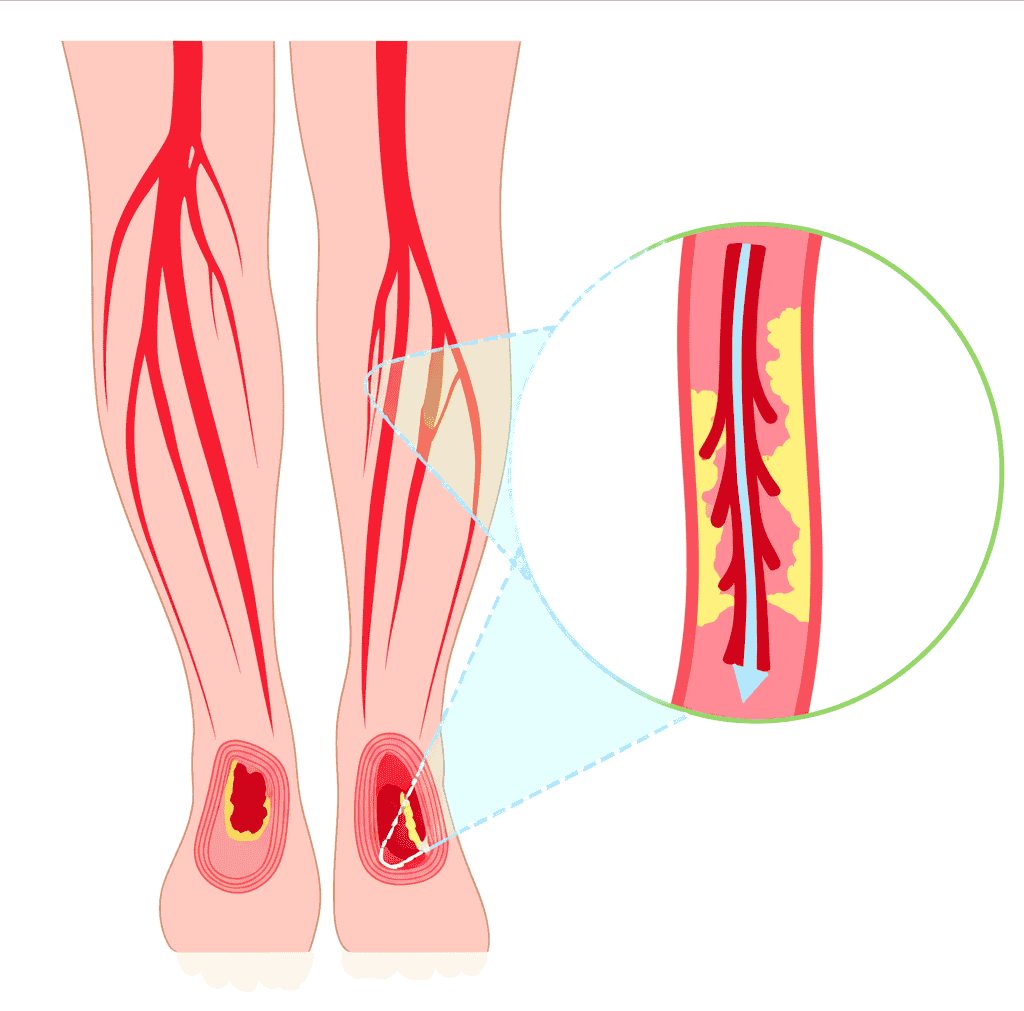 Peripheral Artery Disease services