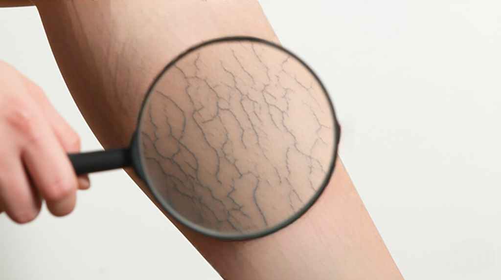 Varicose Veins services offered in Sheboygan and Milwaukee, WI.